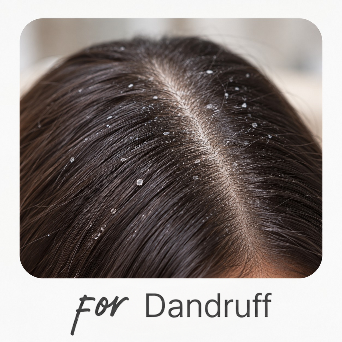 For Dandruff